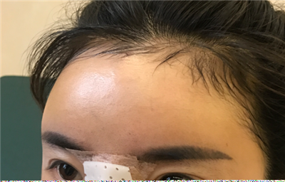 煙臺壹美整形美容醫(yī)院楊彪炳隆鼻案例效果分享