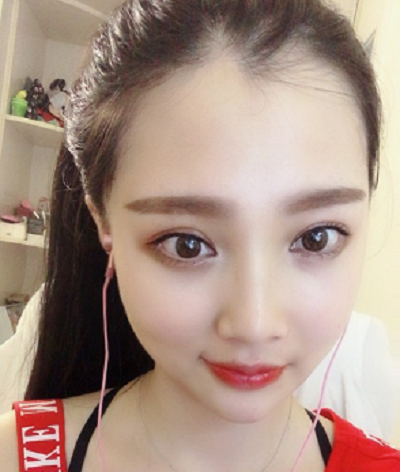鄭州麗天整形美容醫(yī)院做面部吸脂手術后的半個月