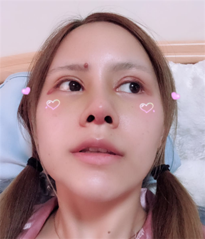 深圳弘美醫(yī)療美容門診部做眼綜合手術后的恢復情況