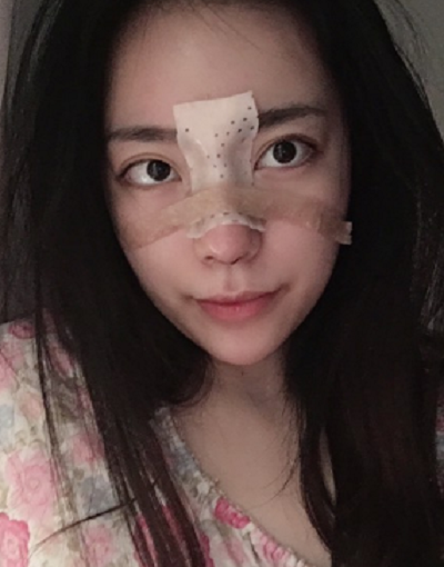 成都漢密爾頓美容醫(yī)院洪偉鼻修復(fù)案例效果分享