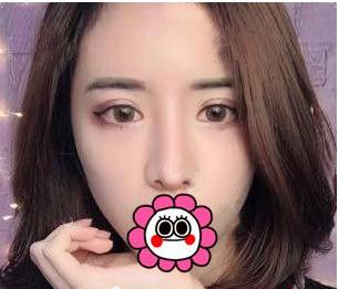 有“鼻王”之稱的楊群申做鼻子到底怎么樣？隆鼻前后圖片
