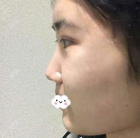 假體隆鼻假嗎？假體隆鼻三個月效果分享