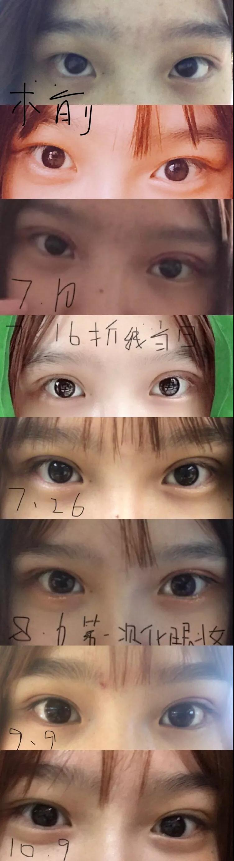 濟南坤如瑪麗崔金珍雙眼皮案例前后對比