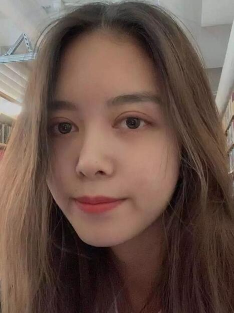 做雙眼皮案例，鄭州壹加壹王洛生全切雙眼皮案例圖片