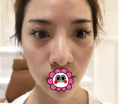 有“鼻王”之稱的楊群申做鼻子到底怎么樣？隆鼻前后圖片