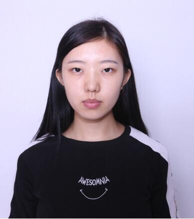 做雙眼皮案例，第四軍醫(yī)大學(xué)唐都醫(yī)院李望舟雙眼皮案例圖片