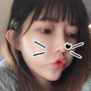 做雙眼皮案例，第四軍醫(yī)大學(xué)唐都醫(yī)院李望舟雙眼皮案例圖片
