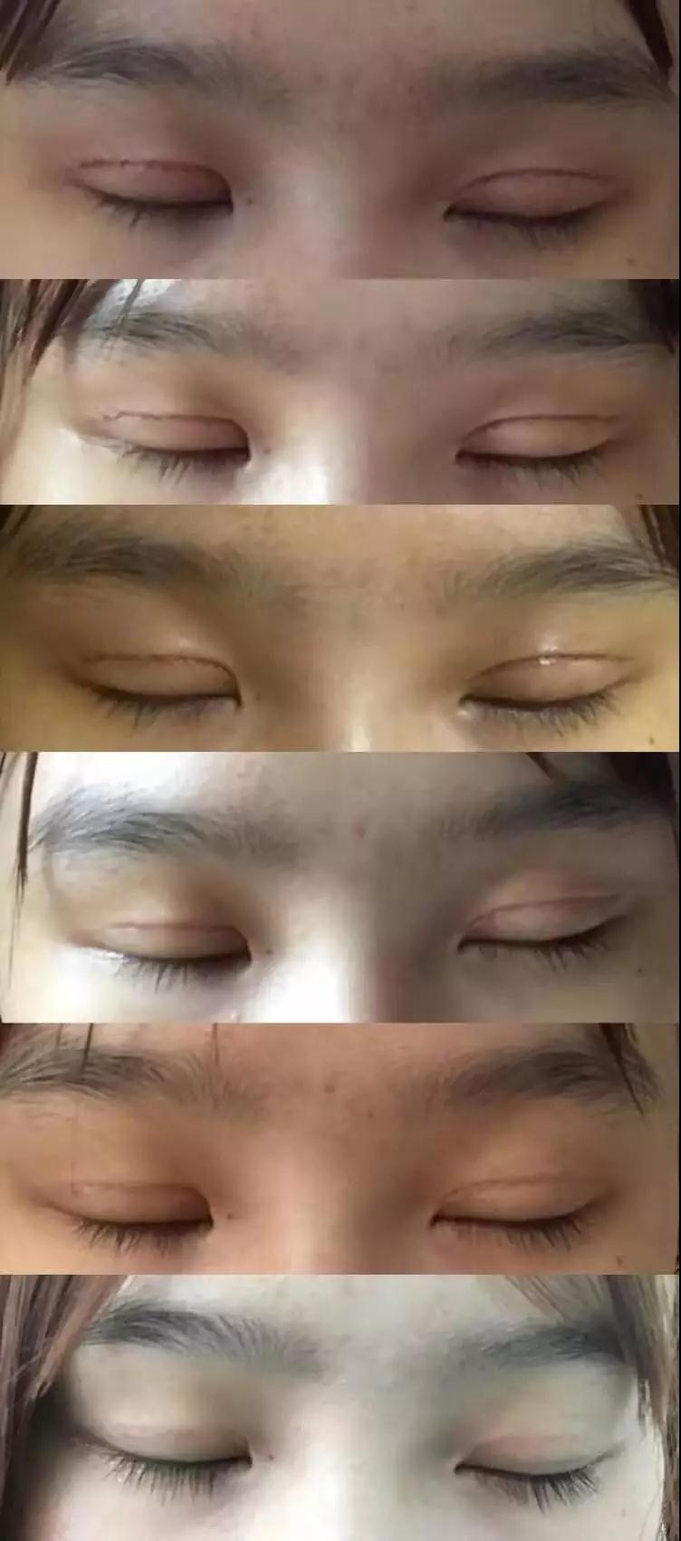 濟南坤如瑪麗崔金珍雙眼皮案例術后閉眼狀態(tài)