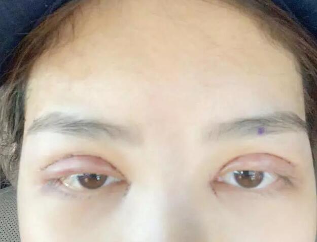 鄭州壹加壹王洛生全切雙眼皮案例術(shù)后第二天