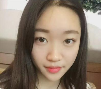 宜昌奧萊楊群申超體隆鼻案例分享，有圖
