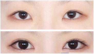桂林柏琳整形開內(nèi)眼角多少錢？開內(nèi)眼角注意哪些?