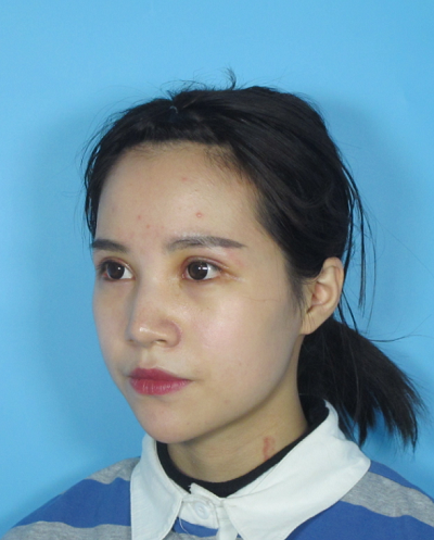 成都美立方（原華博）醫(yī)療美容醫(yī)院做眼部修復(fù)手術(shù)拆線(xiàn)后
