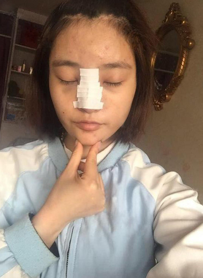上海玫瑰醫(yī)療美容醫(yī)院楊碩成做硅膠隆鼻案例效果分享