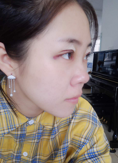 北京東方瑞麗醫(yī)療美容門診部秦繼峰做雙眼皮案例效果分享