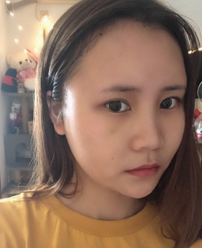 上海美萊醫(yī)療美容門(mén)診部做面部填充術(shù)后的日?；謴?fù)