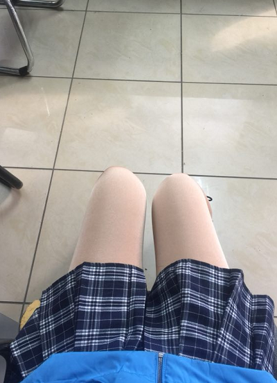 蘇州圣愛醫(yī)院醫(yī)療美容科做大腿吸脂手術后的恢復情況