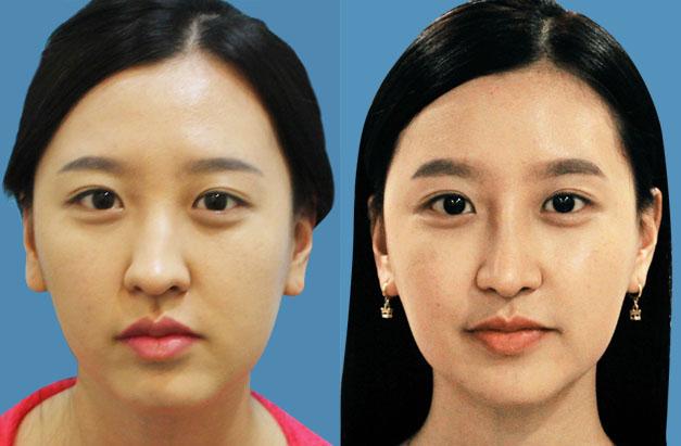 面部不對(duì)稱可以怎么矯正？臉一邊大一邊小怎么矯正？