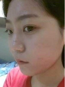上海時(shí)光整形外科醫(yī)院趙克昶做耳軟骨隆鼻案例效果分享
