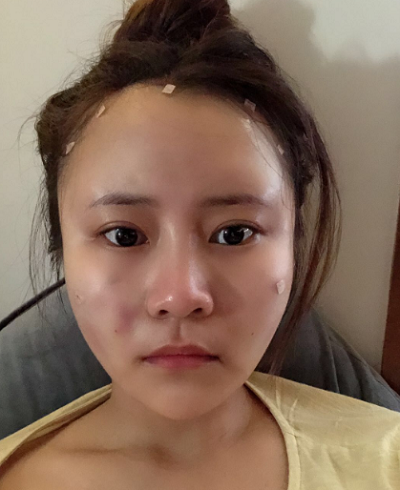 上海美萊醫(yī)療美容門診部白承燦做面部填充案例效果分享