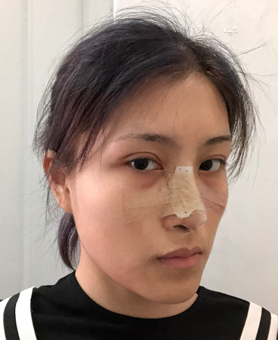 上海港華醫(yī)療美容醫(yī)院王剛做隆鼻案例效果分享