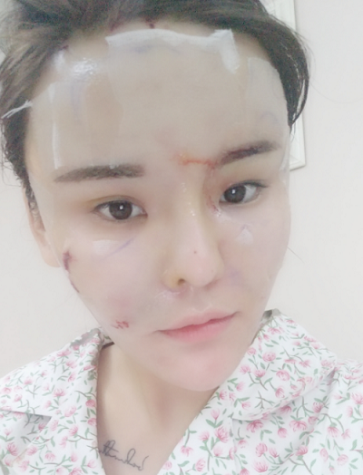 上海美萊醫(yī)療美容門診部熊師做面部填充案例效果分享