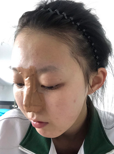 南京美貝爾醫(yī)療美容醫(yī)院黃名斗做自體軟骨隆鼻案例效果分享