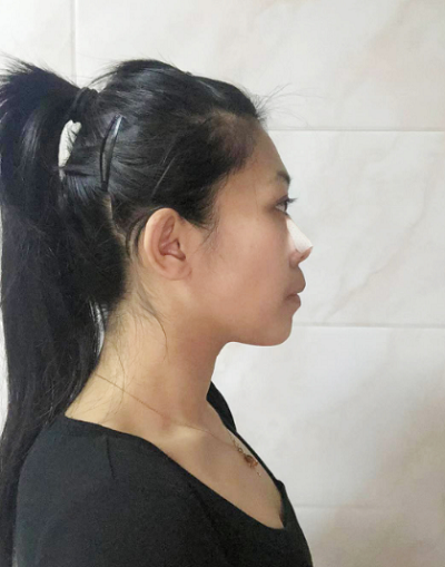 深圳恩吉娜醫(yī)療美容門診部龍維鼻綜合案例效果分享