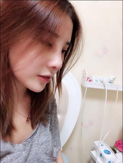上海藝星醫(yī)療美容醫(yī)院做鼻綜合術(shù)后的日?；謴?fù)情況