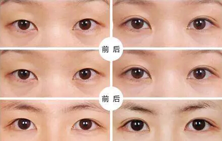 貴州旭美人整形埋線雙眼皮優(yōu)點有哪些如何選擇？