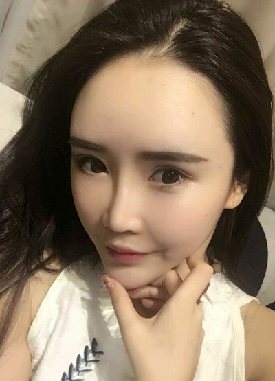 上海伊美爾港華醫(yī)療美容醫(yī)院做自體肋軟骨隆鼻手術(shù)拆線后