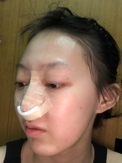 南京美貝爾醫(yī)療美容醫(yī)院做自體軟骨隆鼻術(shù)后要進(jìn)行拆線