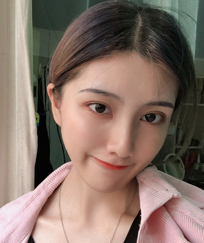 上海港華醫(yī)療美容醫(yī)院王剛做隆鼻案例效果分享